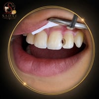 تجميل الأسنان • ابتسامة • النجف