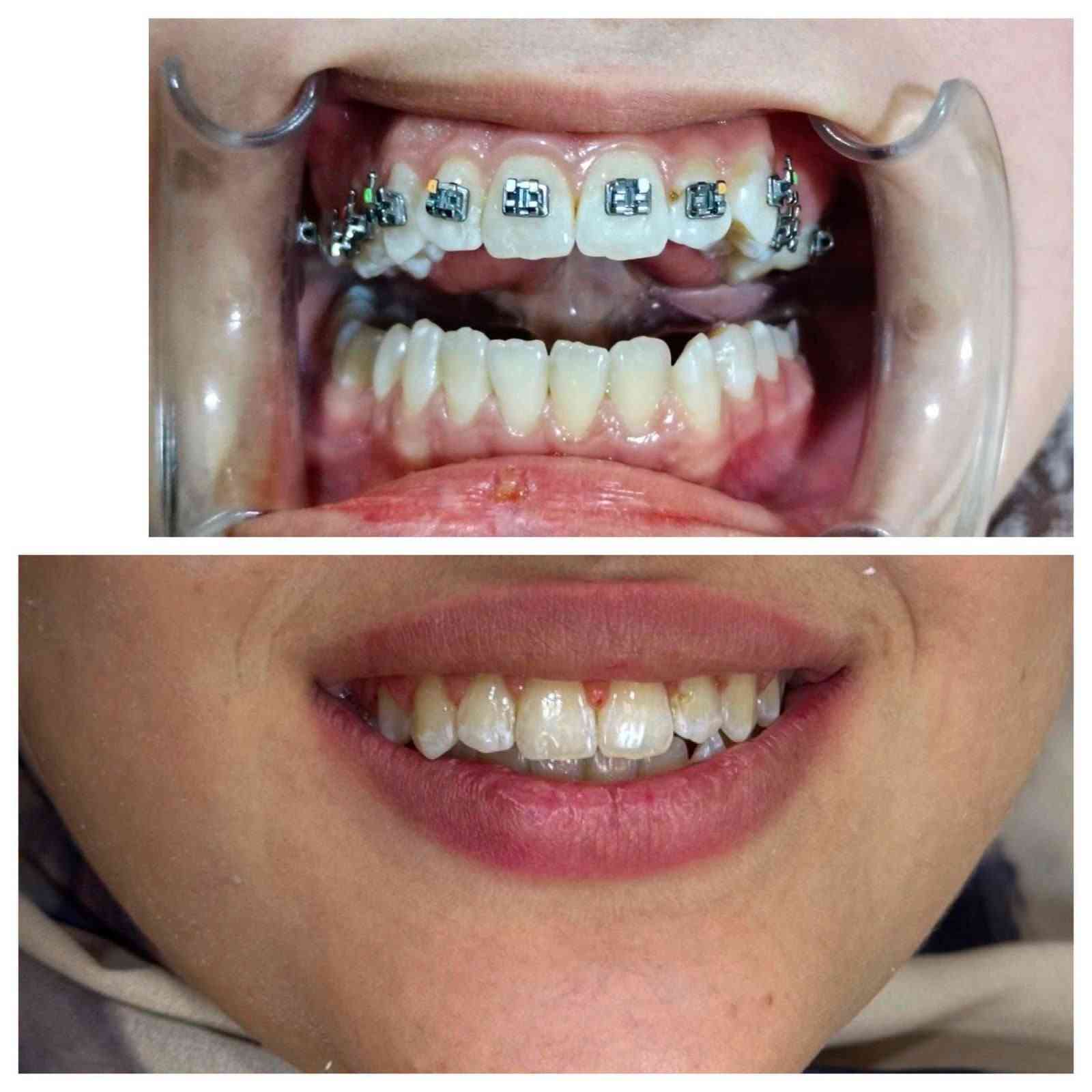 #عيادة طب الاسنان 🦷
#الدكتور فائق أحمد حمود 🩺🥼
#بكالوريوس طب وجراحة الفم والأسنان B.D.S
#يتواجد في العيادة من السبت إلى الخميس مساء 
☎️☎️0️⃣7️⃣8️⃣1️⃣9️⃣1️⃣8️⃣1️⃣8️⃣3️⃣5️⃣♻️📶
♦️يتوفر زراعة الاسنان. ♦️تقويم الاسنان ♦️تركيب الاسنان الثابته والمتحركه. ♦️قلع الاسنان. ♦️تنظيف وتبييض الاسنان بالليزر.♦️ حشوات تجميليه. ♦️حشوات بلاتين. ♦️حشوات الجذور 
#العنوان. الحويجه. شارع الاطباء. الفرع الثاني.
 #مجمع الكندي  الطبي.🏥 
للحجز والاستفسار 
الاتصال على الرقم 📲
***********

نص مكتوب في الصور:
- قبل بعد
- تقويم الاسنان قبل بعد