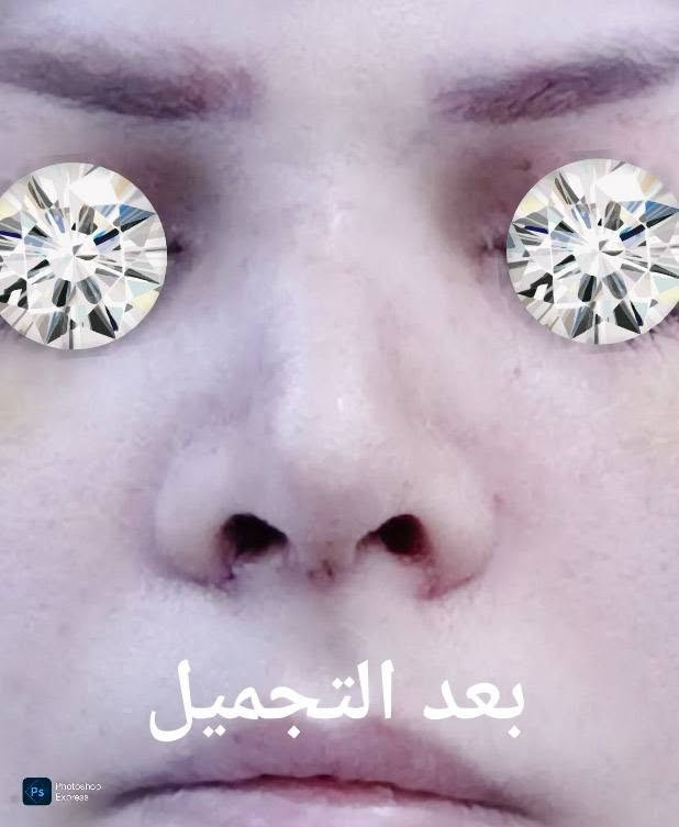 تجميل الانف • بعد رفع القالب • عيادة الياسيري