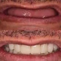 طقم اسنان كامل • مجاناً • بإشراف أطباء