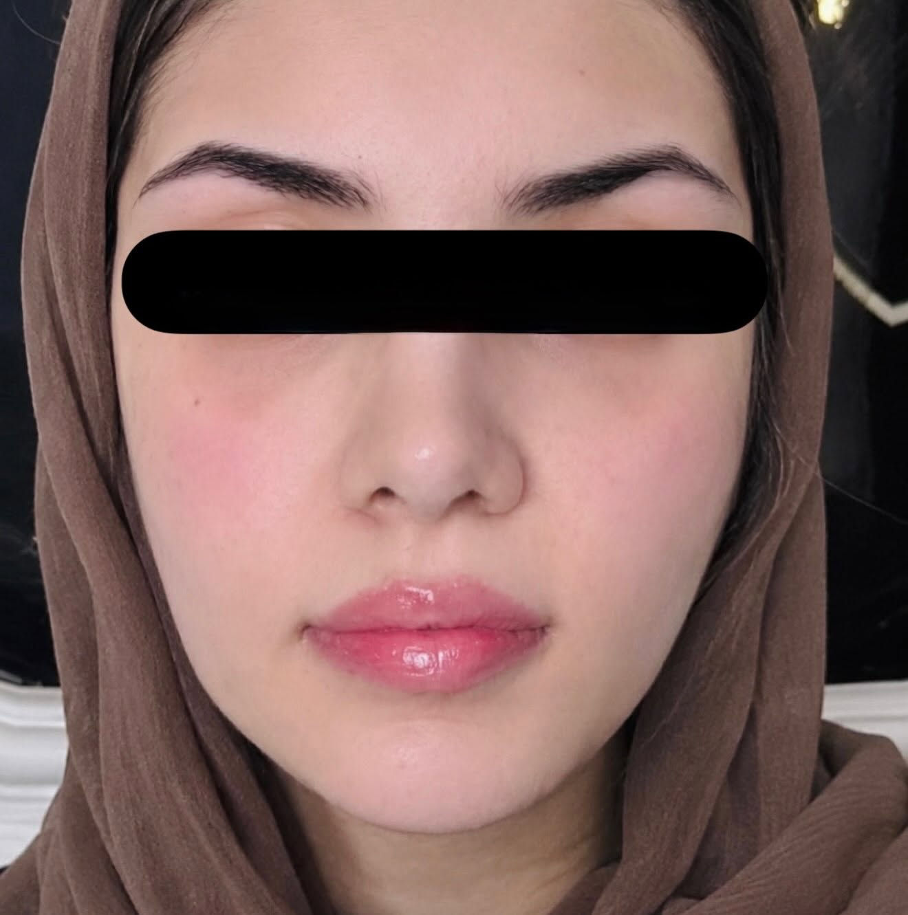 ✨ التغيّر الشامل… ويّانا غير ✨

مو تغيير ملامحك، إنما إبراز جمالك بطريقة ناعمة ومتناسقة 🤍
اشتغلنا على التفاصيل اللي تصنع الفرق: الوجنات، الشفاه والذقن حتى تكون النتيجة متوازنة وتناسب ملامح الوجه.

لأن التجميل الحقيقي مو بكثرة الحقن…
التجميل الحقيقي إن النتيجة تكون محسوبة وتبقى إنتِ، بس بنسخة أجمل من نفسك. 🌷

👩🏻‍⚕️ الدكتورة نور الهدى غانم
📍 الديوانية

#التغير_الشامل #فلر #تجميل_غير_جراحي #فلر_شفايف #فلر_وجنات تجميل_الوجه الدكتورة_نور_الهدى_غانم

نص مكتوب في الصور:
- بعد قبل الدكتورة نور الهدى غانم