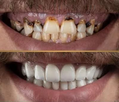 سلام عليكم (((((((العلاج المجاني))))))
اي شخص عنده حالات(تسوس،قلع، تنظيف، طقم اسنان)
يراسلني خاص وعلاج مجاني!!!!!
في عيادات اوروك في منطقة الكراده شارع ٥٢
للتواصل ع ماسنجر او الرقم التالي
 ***********

نص مكتوب في الصور:
- الدكتور أمير علي سعد حشوات ضوئية ( تجميلية ) و معدنية قلع الأسنان و الجذور المتبقية تعويض الأسنان بطقم جزئي متحرك تنظيف الأسنان و أزالة التكاسات و التصبغات *********** ameerali.3 العلاج مجانا تحت إشراف أطباء مختصين عيادات جامعة اوروك - الكرادة - شارع 52
- BIMERISTAN