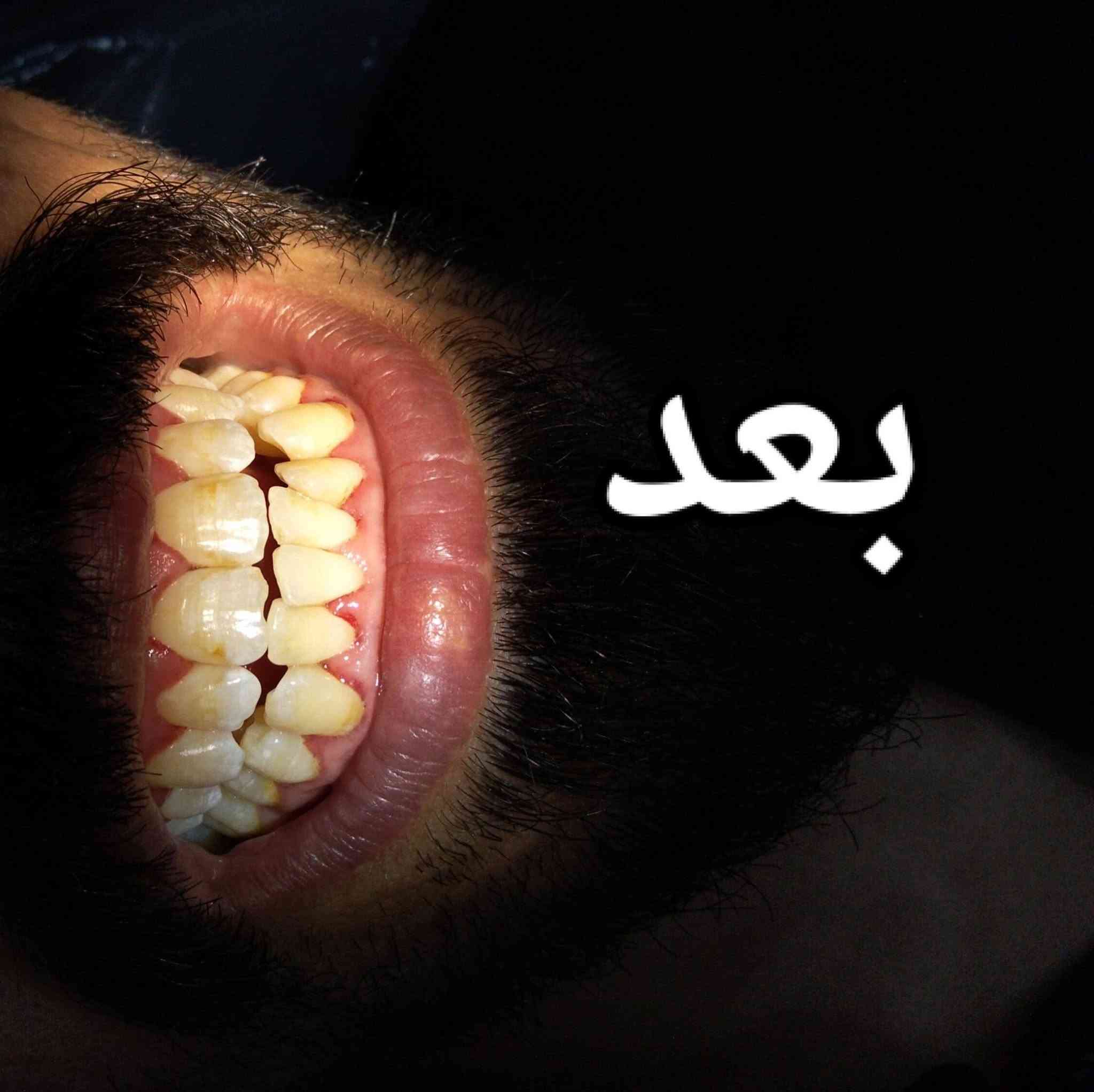 نستقبلكم في عيادة سوريسو
من ساعة الرابعة عصرا إلى الساعة التاسعة ليلا
لتقديم كافة الخدمات السنية من الفحص و التشخيص و العلاج مشاكل الفم و الأسنان
 دقة عالية في العمل و جودة المواد و بأسعار مناسبة
لحجز و الاستفسار على الرقم التالي 
***********
الموقع
حي الحوراء -شارع المواكب-قرب أسواق الزاملي/مقابيل محل الركابي للهاتف النقال
الموقع على الخرائط اضغط على الرابط ادناه⬇️ 
https://maps.app.goo.gl/h7Xz2d9K6H7jFxCR7?g_st=ac
