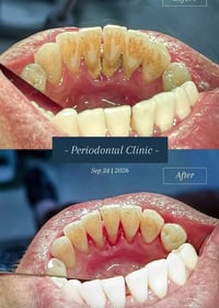 تنظيف أسنان • باجر • جامعة الاسراء