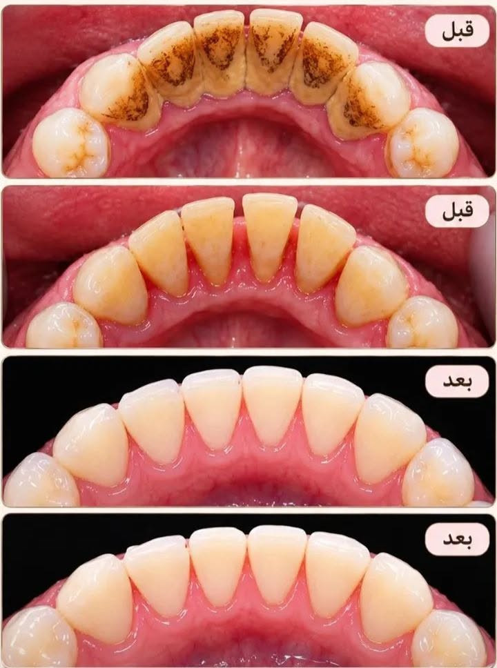 عيادات الجامعة الوطنية • خدمات مجانية • قلع أسنان