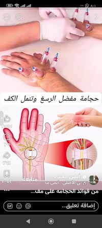 حجامة • تنميل الكف • أيمن محمد