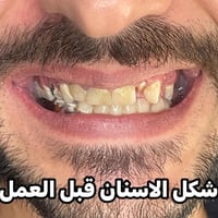 ابتسامة لاتنسى🔥  ابتسامة هوليود تغمرك بالجاذبية والثقة 💜  ابداع الدكتو...