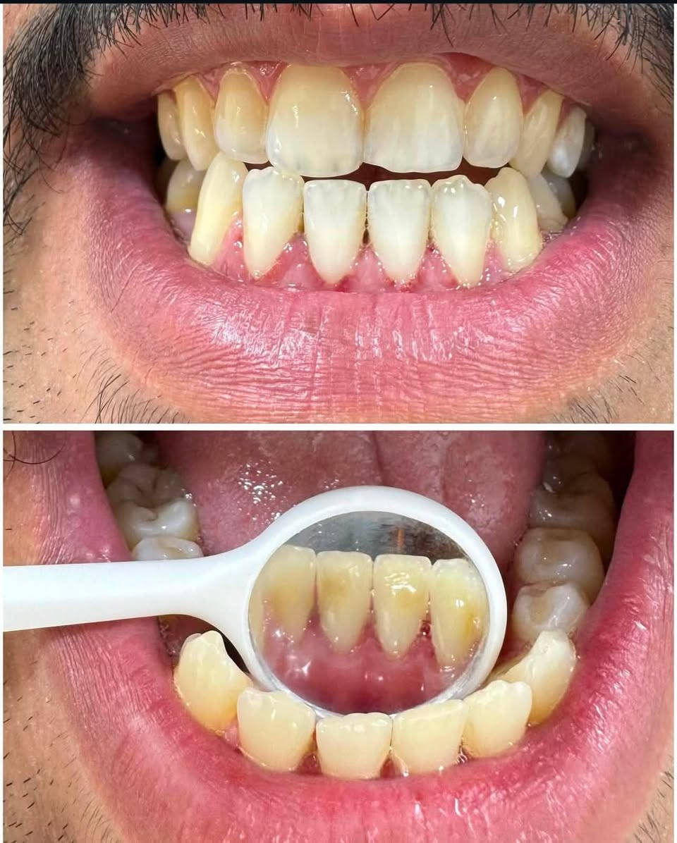 تنظيف الاسنان وازالة التكلسات والتصبغات بجلسة واحدة فقط
في مركز برو لطب وتجميل الاسنان  في عيادة الدكتور محمد قاسم العبودي
المعالجات المتوفرة في المركز:-
-حشوات الجذور ب احدث التقنيات المتوفرة
-زراعة الاسنان
-وتنظيف الاسنان
-قلع الجذور التالفة 
-تركيبات الاسنان والابتسامات التجميلية
العنوان/شارع الاطباء/مقابيل اسواق علي طالب (مركز برو لطب وتجميل الاسنان)
 
طبيب الاسنان :انمار دكلص الزيدي
للحجز والاستفسار واتساب :***********
