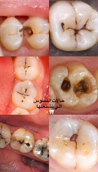 مجاناً • حشوات بيضاء • طالبة طب اسنان
