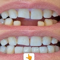 تركيب زركون • ٤أسنان • مشيرفة الأولى