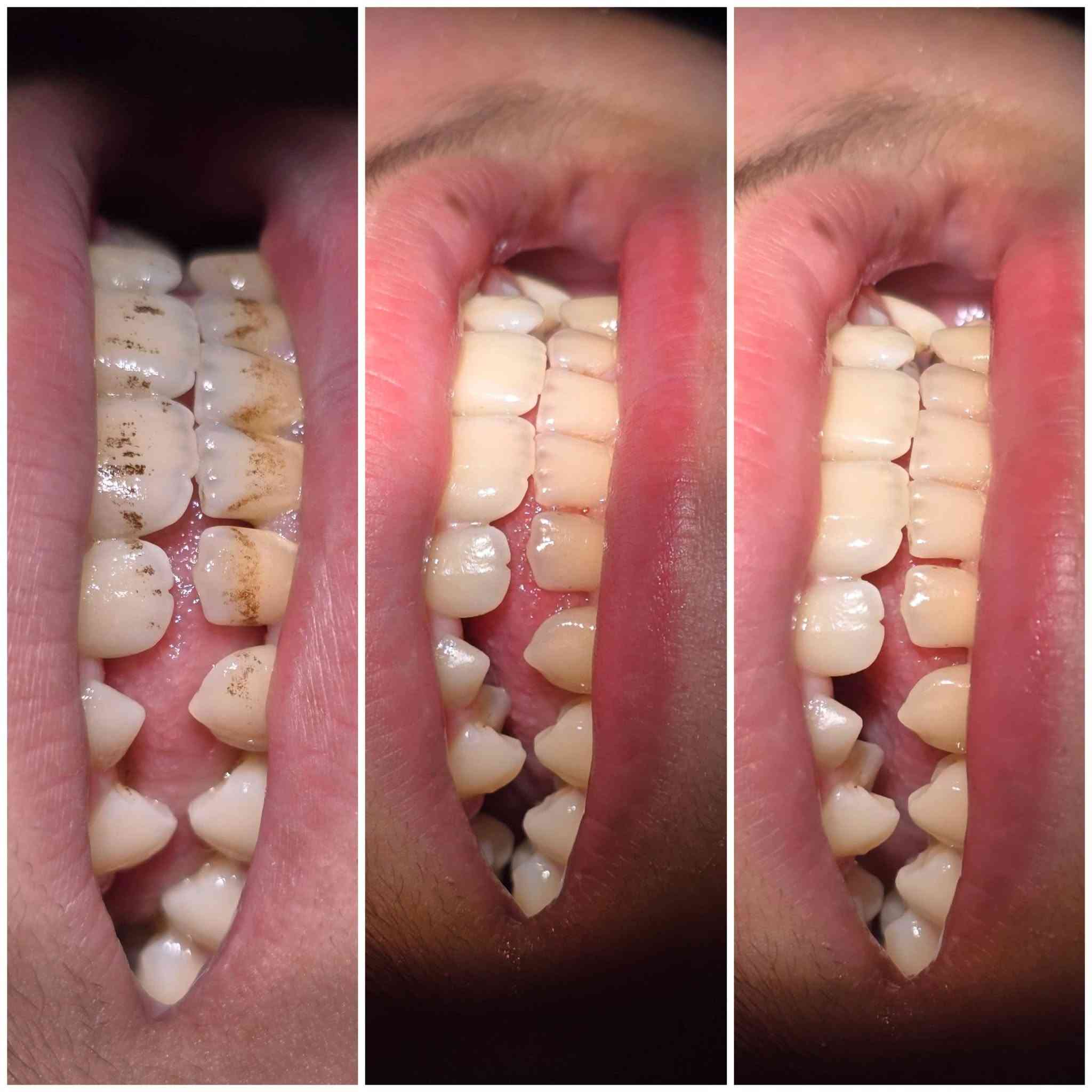 متواجدين يوميا في عيادة اصلان من الساعه الرابعه عصراً
ولقسمين الاسنان والتجميل 
للحجز ***********
