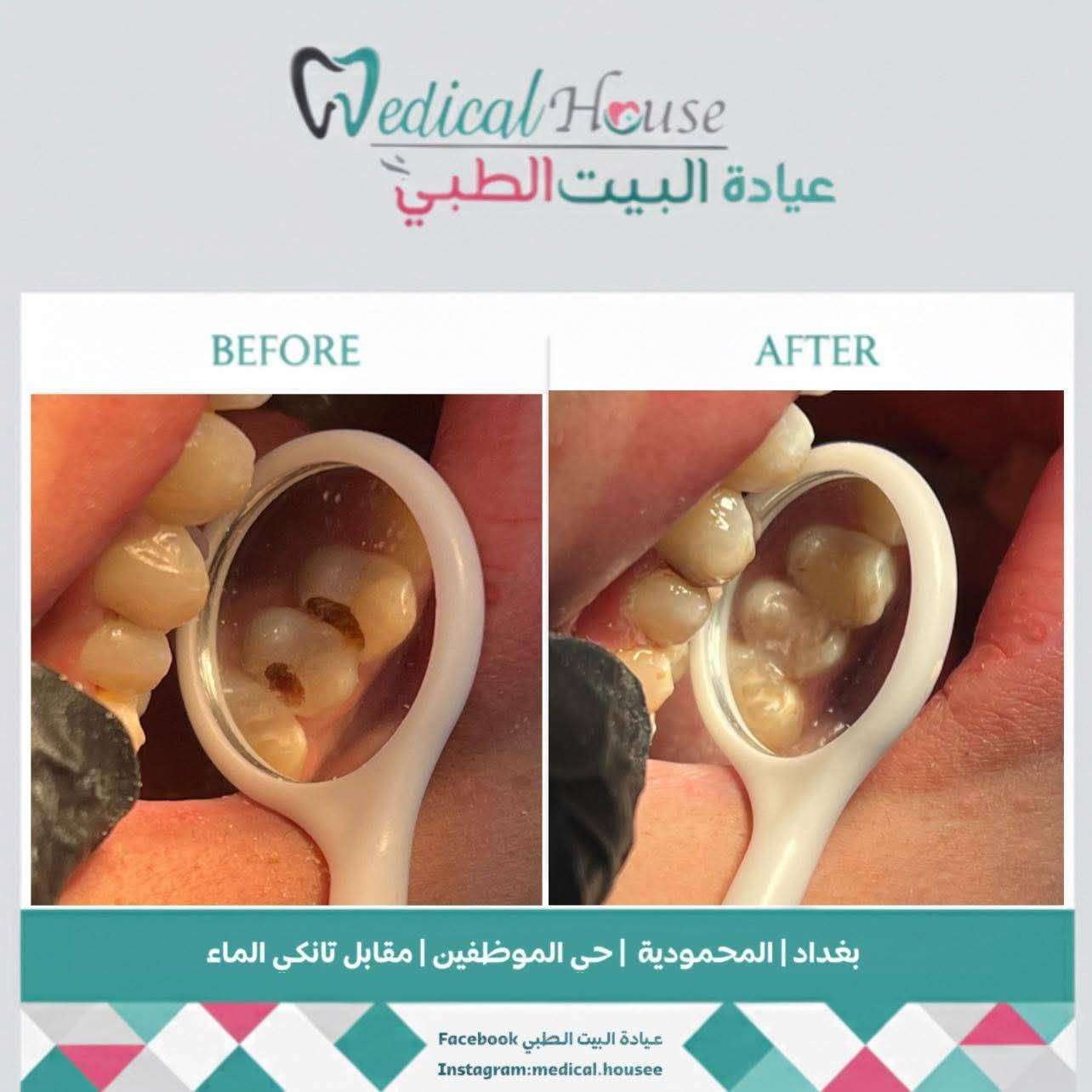 عروض الاسنان يمنه غير والي من طرفي اله خصم خاص من العياده
عيادة ألبيت ألطبي 
🦷 تنظيف وتلميع الأسنان
بدل 25 ألف
صار فقط ٢٠ ألف ✨

🦷 الحشوات الضوئية الدائمية
بدل 50 ألف
صار فقط 30 ألف 😍

🦷 تركيبات الزركون الثابتة
بدل 125 ألف
صار فقط 85 ألف 💎

🦷 تركيبات السيراميك
بدل 100 ألف
صار فقط 70 ألف 🔥

والفحص والمعاينة مجاني
✅ أفضل المواد والأجهزة الحديثة
✅ شغل تجميلي طبيعي ومضمون
✅ أسعار وعروض لفترة محدودة
✅ ابتسامة مرتبة بأقل تكلفة
📍 المحمودية – حي الموظفين – مقابل التانكي
🦷 بكج تنظيف + تلميع + تبييض الأسنان 🤍
تخلّص من التصبغات وتراكمات الأسنان، واسترجع نظافة ولمعان ابتسامتك 
🔥 بكج متكامل بسعر مميز ولفترة محدودة!
✔️ إزالة التكلسات
✔️ تنظيف وتلميع الأسنان
✔️ تبييض الأسنان
✔️ ابتسامة أنظف وأجمل ✨
📍 عيادة البيت الطبي
📞 للحجز والاستفسار: ***********
📲 الحجز متوفر عبر الواتساب

لا تخلي ابتسامتك تنتظر… احجز موعدك الآن �
