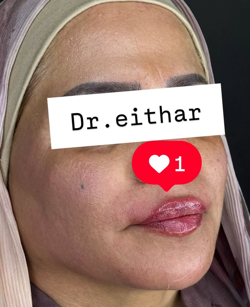 كونتور الوجه بالفلر  (لفتنك وجنات  واصداغ وتدوير الفك والذقن ونظاره وشفة وبوتوكس ) 🔥🔥
لاحضو الفرق بالذقن ومنطقه الفك   شكد تغير الشكل🔥
عروووض للكادر التدريسي والخريجات والموظفات والعروسات  ثبتتهه الكم بالستوري بالهايلايت وببوست اعلى الصفحة ✨✨

د.ايثار سامي عبد الامير
واسط الكوت الهوره مجمع القبطان طابق اول 

الحجز***********

نص مكتوب في الصور:
- Dr.eithar 1
