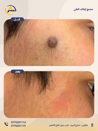 إزالة شامة • تجميل الوجه • خانقين