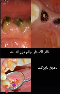قلع أسنان • جذور تالفة • مجاني