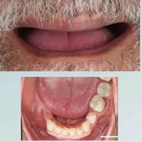 طقم أسنان • مجاني • طقم جزئي متحرك