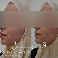 حقن دهون الوجه • استشارة مجانية • د أحمد رامي