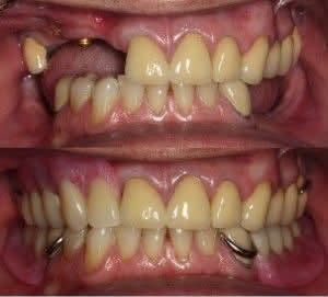بعيادات جامعة كلكامش 🦷
⭕️ نشتغل طقم جزئي متحرك
❗️العلاج تحت إشراف اطباء اختصاص 
📍العنوان : الدورة / ابو دشير / جامعة كلكامش
التواجد : السبت - الاحد - الاثنين
🕙وقت العيادة: 10 
 
📞 واتساب :
 ***********
