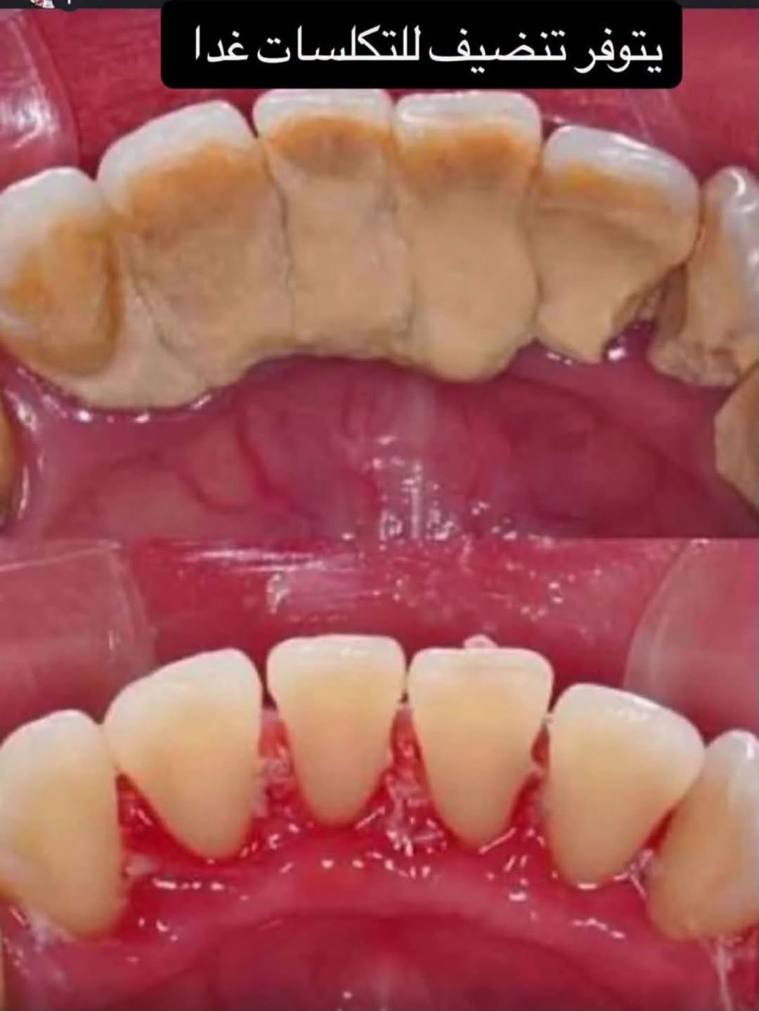 تنظيف تكلسات • جلسة تنظيف • متوفر باچر