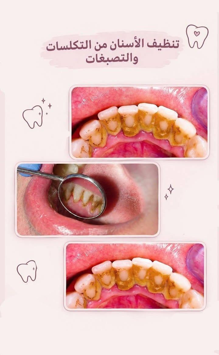 علاج مجاني • عيادات جامعة واسط • تعويض أسنان