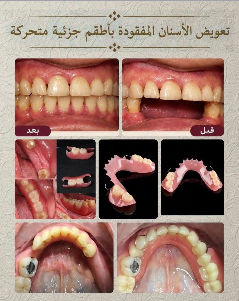 علاج مجاني • عيادات جامعة واسط • تنظيف وحشوات