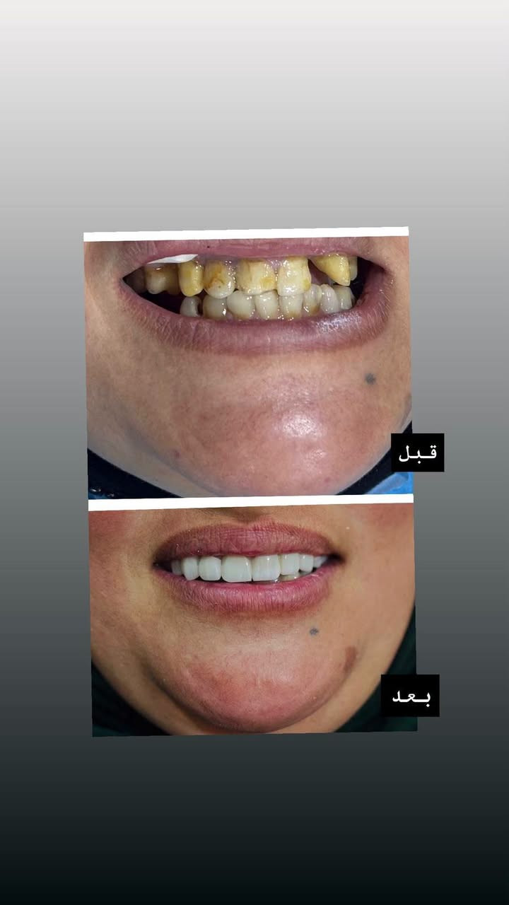 #عيادة طب الاسنان 🦷
#الدكتور فائق أحمد حمود 🩺🥼
#بكالوريوس طب وجراحة الفم والأسنان B.D.S
#يتواجد في العيادة من السبت إلى الخميس مساء 
☎️☎️0️⃣7️⃣8️⃣1️⃣9️⃣1️⃣8️⃣1️⃣8️⃣3️⃣5️⃣♻️📶
♦️يتوفر زراعة الاسنان. ♦️تقويم الاسنان ♦️تركيب الاسنان الثابته والمتحركه. ♦️قلع الاسنان. ♦️تنظيف وتبييض الاسنان بالليزر.♦️ حشوات تجميليه. ♦️حشوات بلاتين. ♦️حشوات الجذور 
#العنوان. الحويجه. شارع الاطباء. الفرع الثاني.
 #مجمع الكندي  الطبي.🏥 
للحجز والاستفسار 
الاتصال على الرقم 📲
***********

نص مكتوب في الصور:
- قبل بعد
- تقويم الاسنان قبل بعد