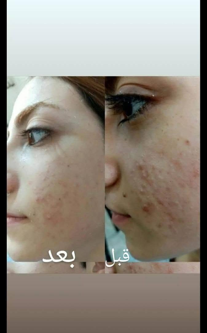 السلام عليكم :
الكتابة
✨ عناية لبشرتك… لأنك تستحق الأفضل ✨
نوفر لكم مجموعة مميزة من منتجات العناية بالبشرة للرجال والنساء 🧴💆‍♀️💆‍♂️
🇮🇷 منتجات إيرانية من شركة لدورة 🌿
💗 منتجات للنساء والرجال
💗 استشارة مجانية لاختيار المنتج المناسب
💗 متابعة الزبون كل أسبوع
💗 متابعة مستمرة وإرشادات لطريقة الاستخدام
📲 متواجدين على الواتساب للاستفسار والطلب:
***********
***********
✨ تواصلوا ويانا، والاستشارة مجانية ✨

نص مكتوب في الصور:
- بعد استعمال بكج التساقط من ماركة لدورا
- قبل بعد
- بشره تعاني من الكلف وحساسيه بالدم بعد استخدام منظف شيرباكون+مصل الكافيار لمدة ١٠ ايام
- بعد استخدام ١٠ ايام من المنتجات
- بعد
- قبل
- بعد استخدام عصاره الليكس