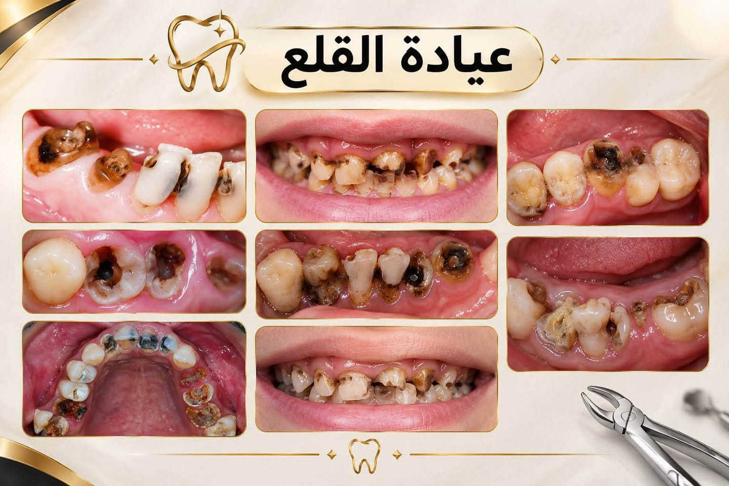 الـسلام عليكم
العلاج مجـاني  بالكامل 
متوفر قلع الاسنان التالفة وبقايا الجذور وتعويضها بطقم متحرك تنظيف حشوات ضوئية كلشي معقم ونظيف تحت اشراف اطباء مختصين

نص مكتوب في الصور:
- دكتورة زينب فرحان طالبة طب وجراحة الفم والأسنان الخدمات المتوفرة قلع الأسنان حشوات تجميلية تركيب طقم أسنان تنظيف الأسنان مكان العيادة كلية طب الأسنان جامعة دجلة *********** @bk__ares نعني بابتسامتك لأنك تستحق الأفضل
- عيادة تنظيف الاسنان
- عيادة القلع
- عيادة الحشوات
- عيادة ( طقم الاسنان الجزئي )