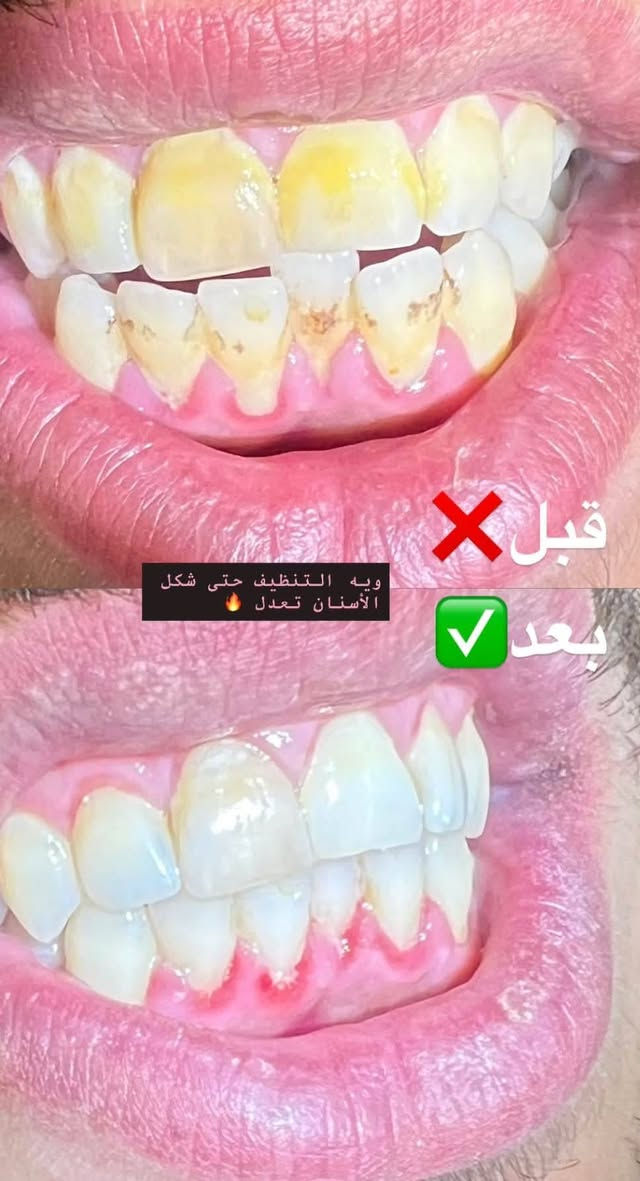 تنظيف اسنان • علاج تسوس • باب المعظم