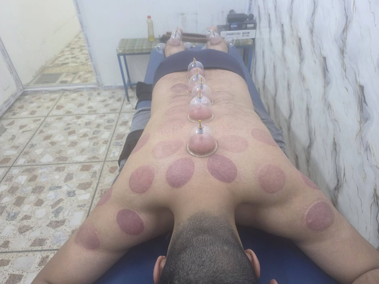 حجامة دموية • حجامة جافة • مساج