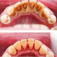 تنظيف أسنان مجاني • تكلسات • قبل وبعد