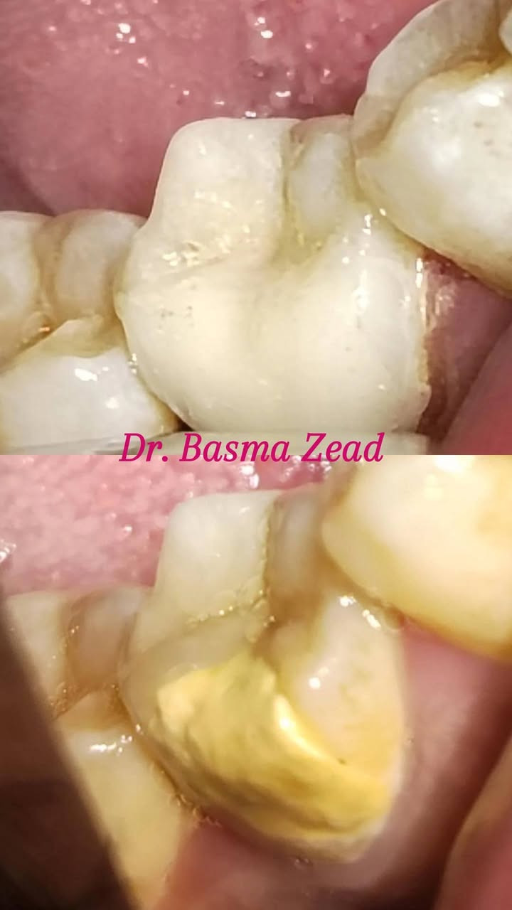 سلام عليكم ورحمة الله وبركاته
✨ فرصة مميزة لعلاج أسنانك بأسعار رمزية 🦷
طبيبة أسنان حاصلة على عدة شهادات ودورات تدريبية في مجال طب الأسنان، تقدم خدمات علاجية لمختلف الحالات بأسعار رمزية تصل إلى نصف السعر.
🔹 يشمل استقبال مختلف الحالات السنية
🔹 أسعار مناسبة ومخفضة
🔹 يتم توثيق ودراسة كل حالة ضمن بحث علمي بهدف تطوير الخبرة والجانب العلمي والسريري.
🔷 بيئه آمنه ومعقمه لكل مراجع ادوات خاصه به يتم التخلص منها بعد انتهاء الجلسه. 
📍 للحجز والاستفسار:
📱 واتساب: ***********

العلاج بامانه تامه ويوجد كارت ضمان مع تقرير كامل لحالة كل مريض وتتوفر صور لحالات علاجية من شغلنا على صفحتي الخاصه 📸
