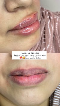 بسماية • فلر شفايف • تقسيط بدون مقدم