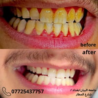 تنظيف اسنان • ازالة تكلسات • جامعة البيان