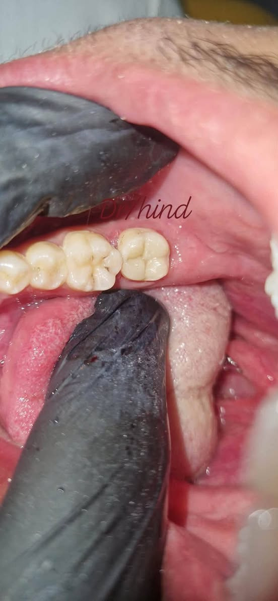 جزء من شغلنا بـ الحشوات التجميلية 🦷✨

مو بس حشوة… نرجّع شكل السن ونخليه يندمج ويا الابتسامة بشكل مرتب وطبيعي 😍

شغل نظيف وتفاصيل تفرق بالابتسامة 🤍

📍 بغداد – الأمين الثانية – شارع المهداوي
📞 *********** @highlight
