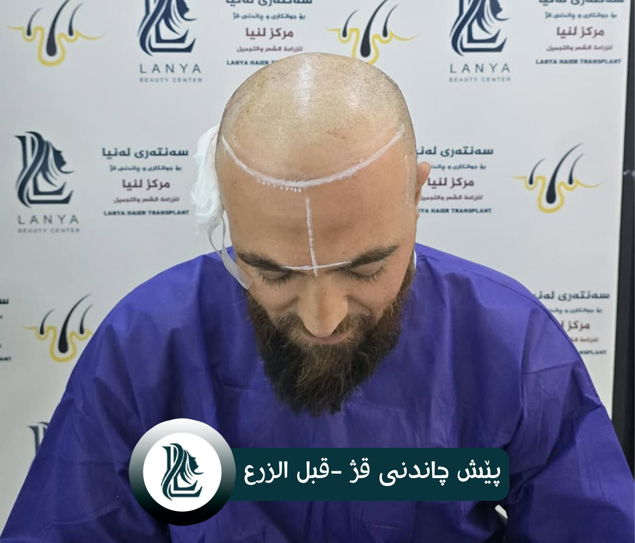 زراعة شعر • لەنیا • كلار