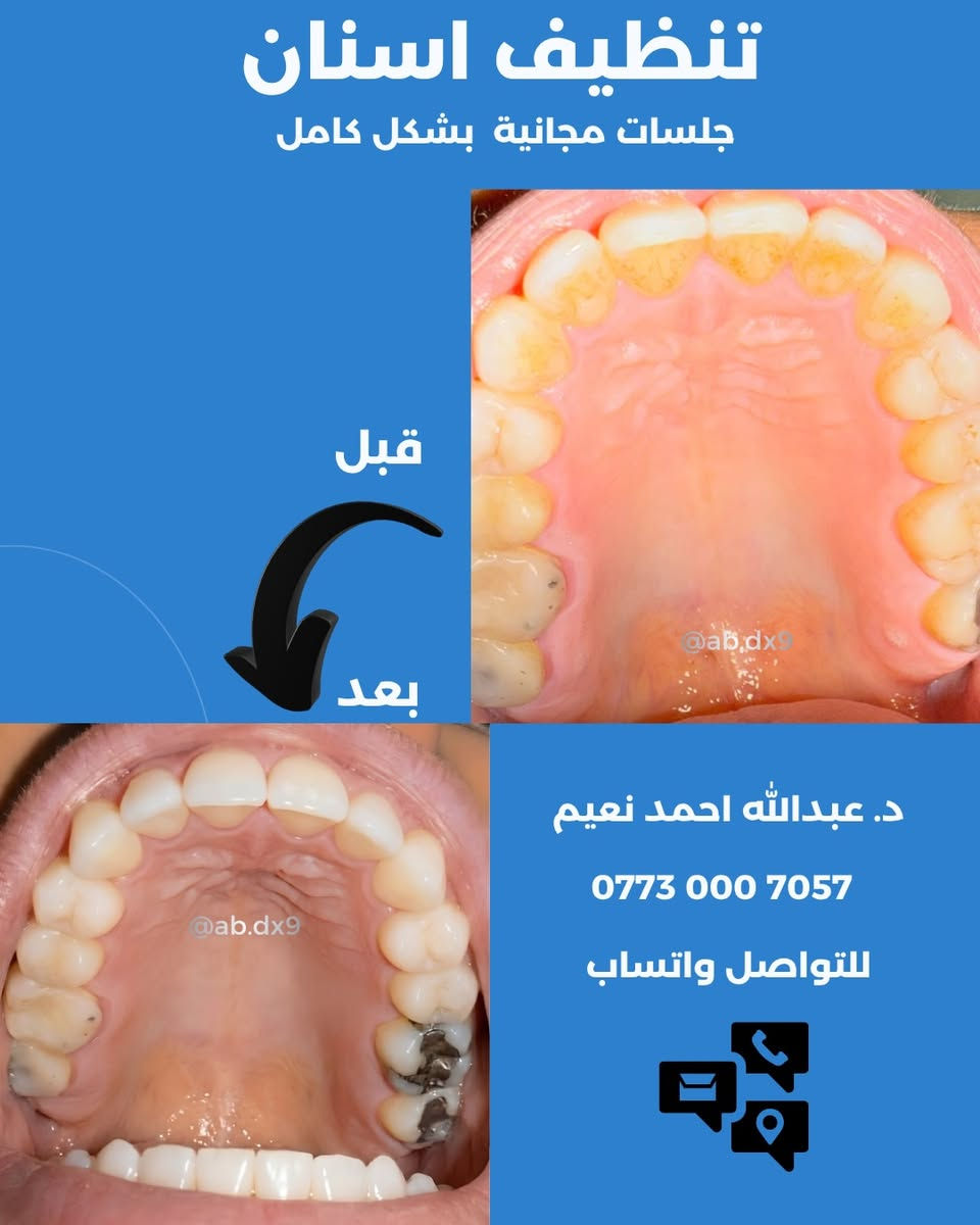 تنظيف اسنان • جلسات مجانية • اليرموك الأربع شوارع