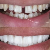 تقويم أسنان • فرق بين الاسنان • جامعة الحلة