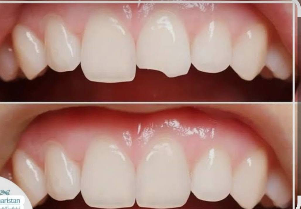 سن مكسور • ترميم سن • جامعة ابن سينا