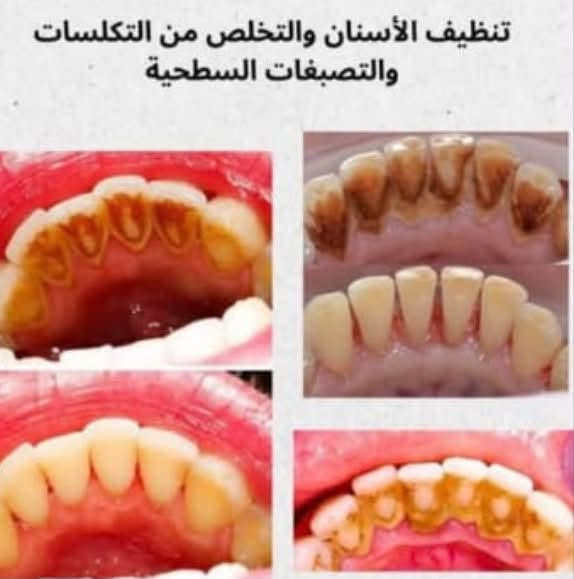 الي محتاج قلع او حشوات او تعويض طقم جزئي او تنظيف اسنان…
الحجز على الخاص او مراسلة الرقم *********** واتساب…(علما ان العلاج مجاني وتحت إشراف اطباء اختصاص)
📌العنوان: بغداد / حي القاهرة / عيادات كلية الرافدين

نص مكتوب في الصور:
- تنظيف الأسنان والتخلص من التكلسات والتصبغات السطحية
- Before After
