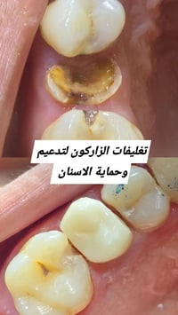 تغليف زاركون • تدعيم اسنان • حسينية المعامل