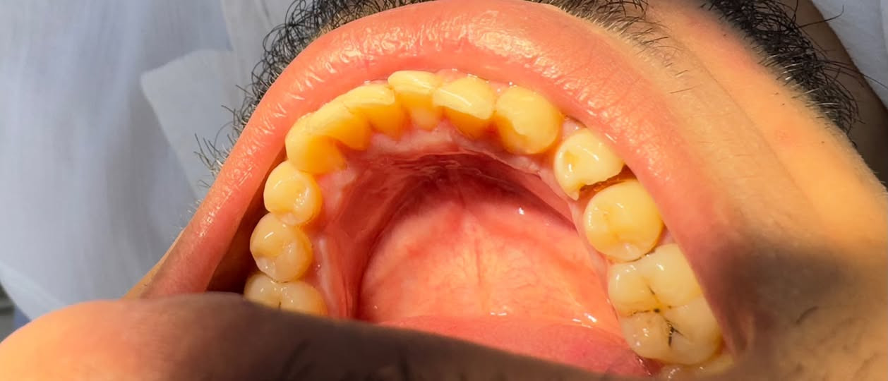 🦷 محتاجين علاج أسنان؟
إذا تحتاجون:
✨ تنظيف أسنان
🦷 قلع سن
🪥 حشوات أسنان

راسلوني هنا بالخاص 💌
أو على الواتساب:
📱 ***********

📍 العلاج يتم تحت إشراف طبيب مختص.
