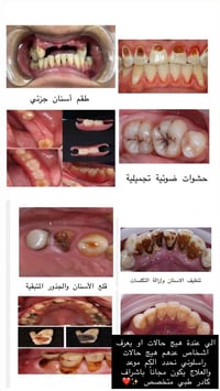 علاج مجاني • جامعه دجله الاهليه • طقم اسنان