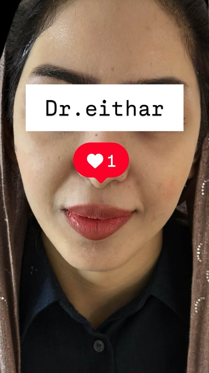 كونتور الوجه وشد بالفلر  (لفتنك وجنات  واصداغ وتدوير الفك والذقن ونظاره) 🔥🔥🔥

اتمددت عروووض للكادر التدريسي والخريجات والموظفات والعروسات لنهايه الاسبوع ليوم الاربعاء اخر يوم  ثبتتهه الكم بالستوري بالهايلايت وببوست اعلى الصفحة ✨✨

د.ايثار سامي عبد الامير
واسط الكوت الهوره مجمع القبطان طابق اول 

الحجز***********

نص مكتوب في الصور:
- Dr.eithar 1
- Dr.eithar
- 1