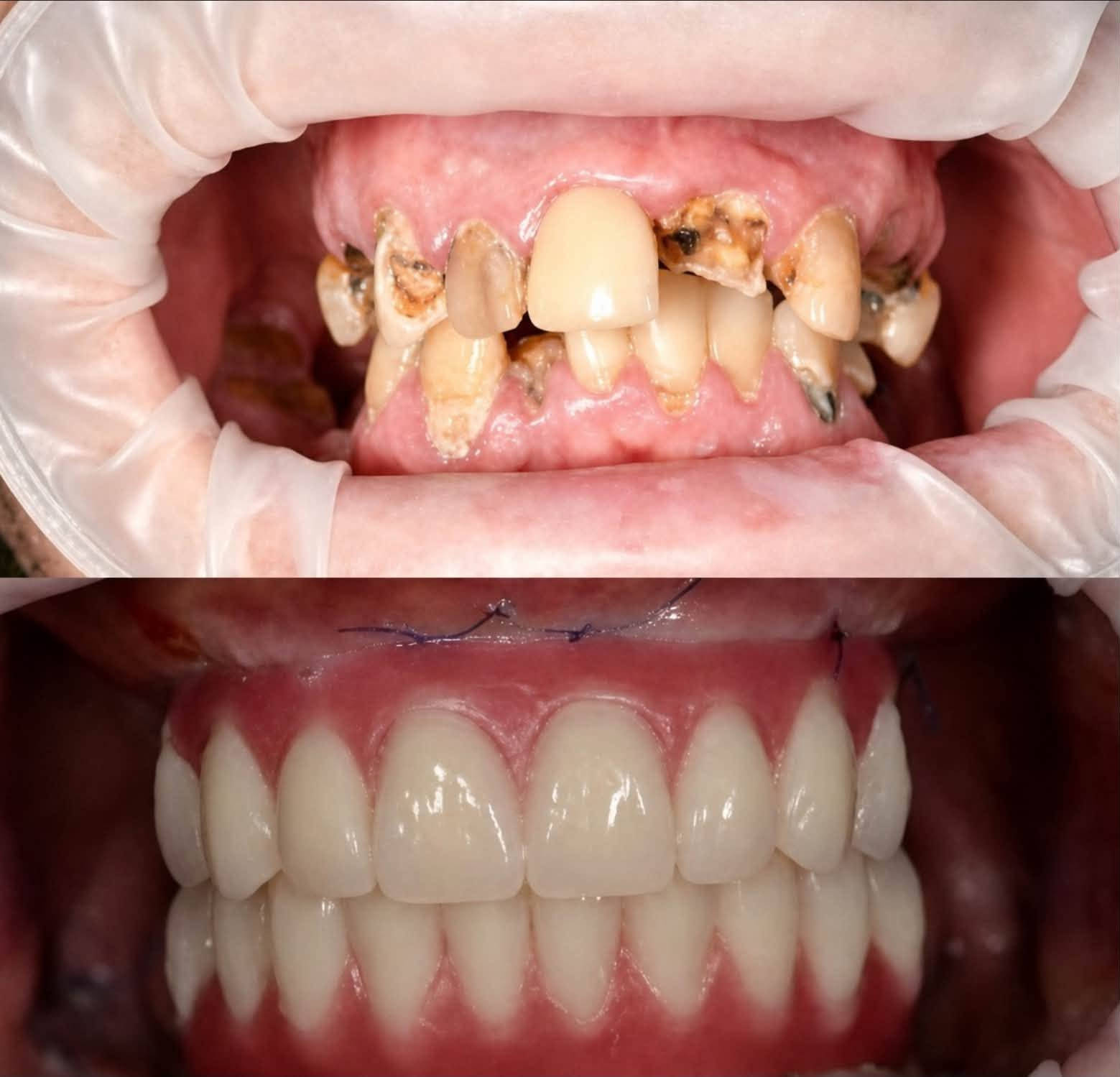 علاج مجاني الى اهالي البصرة  
حشوات تجميلية ، تنظيف الاسنان , قلع الاسنان والجذور النتبقية , تركيب طقم اسنان جزئي كل هذا مجاني تحت اشراف اطباء مختصين
للتواصل والاستفسار ***********
