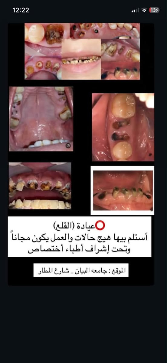 السلام عليكم للفائده
الي من بغداد ومحتاج قلع اسنان /تنظيف اسنان/حشوات ضوئيه /تعويضات اسنان وطقم كامل او جزئي / وايضا نشتغل اطفال كل الحالات 

يراسلني على الخاص او على الرقم *********** علما ان العلاج مجاني

نص مكتوب في الصور:
- عيادة الحشوات أستلم بيها هيج حالات العمل يكون مجاناً تحت إشراف اطباء اختصاص الموقع: جامعه البيان - شارع المطار
- عيادة (القلع) أستلم بيها هيج حالات والعمل يكون مجاناً وتحت إشراف أطباء أختصاص الموقع : جامعه البيان - شارع المطار
- عياده تنظيف الأسنان
- ألي عنده هيج حاله ويحب يسويلها تنظيف يتواصل
- الموقع : جامعه البيان _ شارع المطار