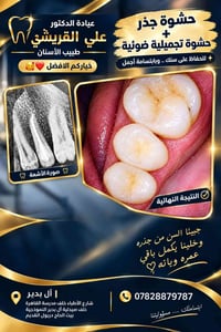 حشو جذر • حشوة تجميلية ضوئية • عيادة علي القريشي