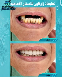 تغليف زيركون • مجمع اليمامه • خبرة ٢٢سنة