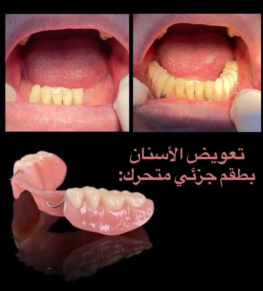 السلام عليكم
حالات مطلوبة للعلاج في جامعة المستقبل والعلاج مجاني 
1-حشوات لاغلب حالات التسوسات 
2-تنظيف اسنان من التكلسات والتصبغات 
3-قلع الجذور المتبقية والاسنان الهالكة غير قابلة للعلاج
4-تعويض الاسنان المفقودة بطقم جزئي متحرك
*علمًا العلاج يبدأ في بداية الاسبوع المقبل للحجز والاستفسار التواصل على
واتساب//***********
او انستا // zozo_zozoo17

نص مكتوب في الصور:
- 1-التسوس يكون بوسط السن. 2-تسوس بين الأسنان. (الأسنان الخلفية) 3-تسوس بين الأسنان. (الأسنان الأمامية) 4-تسوس او كسر للحافة القاطعة للأسنان الأمامية. 5-تسوس عند حافة اللثة.
- حالات القلع:
- تعويض الأسنان بطقم جزئي متحرك: