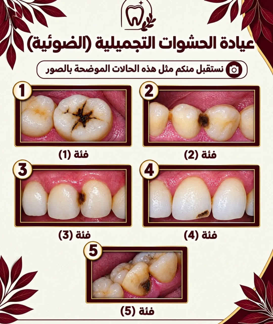 قال تعالى 
﴿وَمَا تَوْفِيقِي إِلَّا بِاللَّهِ ۚ عَلَيْهِ تَوَكَّلْتُ وَإِلَيْهِ أُنِيبُ﴾

بعد سنوات من الدراسة والتعلم النظري والعملي، أبدأ مرحلة جديدة ومهمة في مسيرتي كطالب طب أسنان: العيادات السريرية.
خلال هذه المرحلة سأشارككم جانبًا من الحالات والخدمات التي نستقبلها في العيادات السريرية، بالإضافة إلى معلومات ونصائح بسيطة تساعدكم على الاهتمام بصحة الفم والأسنان.
📍 جامعة العين العراقية – المستشفى التعليمي لكلية طب الأسنان
إذا كنت بحاجة إلى إحدى الخدمات التي نعلن عنها، يمكنك التواصل معي عبر الرسائل لمعرفة التفاصيل ومواعيد الاستقبال.

#الناصرية #طب_اسنان #العراق #اكسبلور

نص مكتوب في الصور:
- د. الحسن علي العبودي طالب طب أسنان تنظيف الأسنان من التصبغات و إزالة التكلسات معالجة الأسنان بالحشوات الضوئية (التجميلية) قلع الأسنان والجذور التالفة تعويض الأسنان المفقوده بطقم جزئي متحرك الموقع شارع النيل _ حي الشهداء _ جامعة العين العراقية _ المستشفى التعليمي لكلية طب الأسنان ملاحظة وذلك بأشراف نخبة من الأطباء المختصين مع إستخدام أحدث الأجهزة و المواد لضمان أفضل النتائج و العلاج مجاني بالكامل alhassanalii19 *********** ***********
- عيادة تنظيف وإزالة تكلسات الاسنان نستقبل منكم مثل هاي الحالات الموضحه بالصور حماية من أمراض اللثة أسنان أنظف ونفس منعش وقاية من تسوس الأسنان صحة فم أفضل الي عنده مثل هاي الحالات او يعرف شخص آخر محتاج تنظيف فخلي يتواصل معنا
- عيادة قلع الأسنان نستقبل منكم مثل هاي الحالات الموضحة بالصور سن متسوس سن مكسور سن متآكل بشدة سن متحرك تسوس عميق الأسنان المسببة للزحام سن مصاب بالعدوى تسوس كبير سن غير قابل للترميم فشل علاج العصب سن لبني متبقي سن تالف لا يمكن ترميمه حماية من أمراض اللثة أسنان أنظف ونفس منعش وقاية من تسوس الأسنان صحة فم أفضل
- عيادة الحشوات التجميلية (الضوئية)
- نستقبل منكم مثل هذه الحالات الموضحة بالصور
- 1
- فئة (1)
- 2
- فئة (2)
- 3
- فئة (3)
- 4
- فئة (4)
- 5
- فئة (5)
- عيادة التعويضات السنية المتحركة
- (في الفكين العلوي و السفلي)
- صحة فم أفضل
- وقاية من تسوس الأسنان
- أسنان أنظف ونفس منعش
- حماية من أمراض اللثة